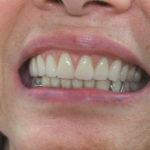 Съемные зубные протезы: какие лучше, отзывы