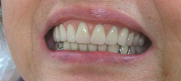 Съемные зубные протезы: какие лучше, отзывы