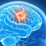 восстановление после перенесенного инсульта